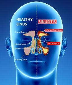 sinus sinusitis sinuses head otolaryngology congestion disorders nasal ent mengobati aguda cough mengganggu cavities bacteria ceria sihat gaya voice